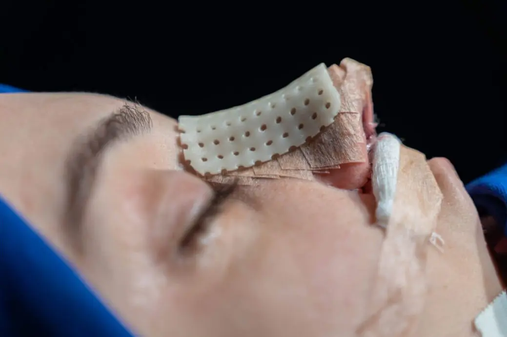 Detalhe de cirurgia de rinoplastia